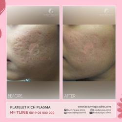 PLATELET-RICH-PLASMA-01