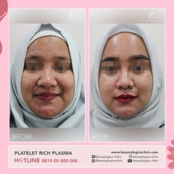 PLATELET-RICH-PLASMA-02