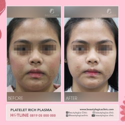 PLATELET-RICH-PLASMA-03