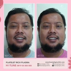 PLATELET-RICH-PLASMA-04