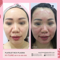 PLATELET-RICH-PLASMA-05