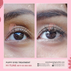 PUFFY-EYES-TREATMENT-01