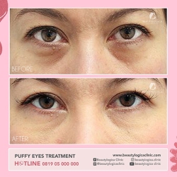 PUFFY-EYES-TREATMENT-02