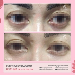 PUFFY-EYES-TREATMENT-03
