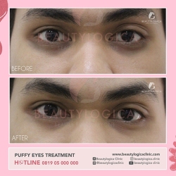 PUFFY-EYES-TREATMENT-04