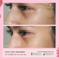 PUFFY-EYES-TREATMENT-05