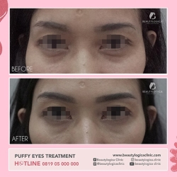 PUFFY-EYES-TREATMENT-06