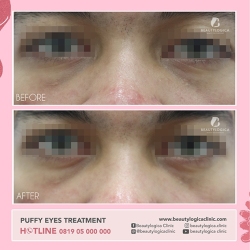 PUFFY-EYES-TREATMENT-07