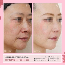 SKIN-BOOSTER-INJECTION-01
