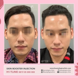 SKIN-BOOSTER-INJECTION-02