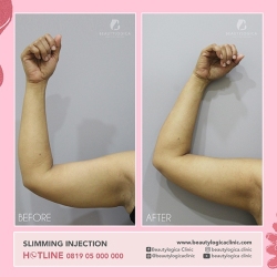 SLIMMING-INJECTION-01