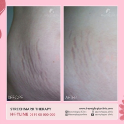 STRECHMARK-THERAPY-02