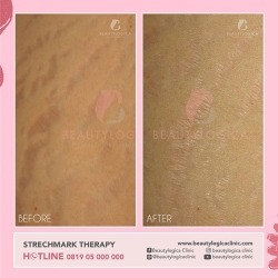 STRECHMARK-THERAPY-03