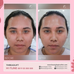 THREADLIFT-01
