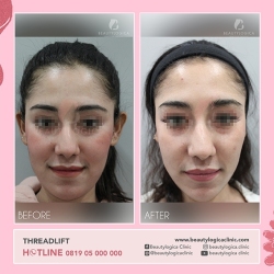 THREADLIFT-02