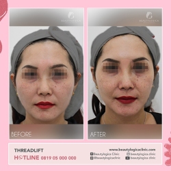 THREADLIFT-03