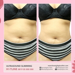 ULTRASOUND-SLIMMING-01