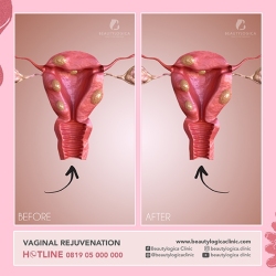 VAGINAL-REJUVENATION-01