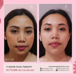 VSHAPE-FACE-THERAPY-01