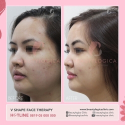VSHAPE-FACE-THERAPY-02