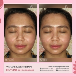 VSHAPE-FACE-THERAPY-03