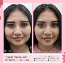 VSHAPE-FACE-THERAPY-04