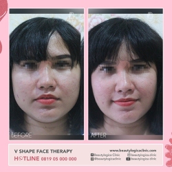 VSHAPE-FACE-THERAPY-05
