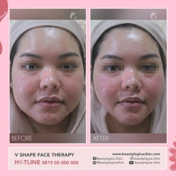 VSHAPE-FACE-THERAPY-06