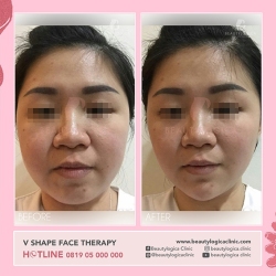 VSHAPE-FACE-THERAPY-07