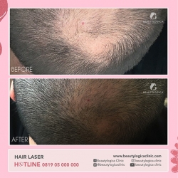 1_HAIR-LASER-01