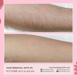 1_HAIR-REMOVAL-WITH-IPL-01