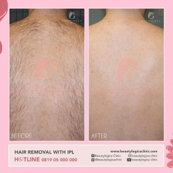 1_HAIR-REMOVAL-WITH-IPL-02
