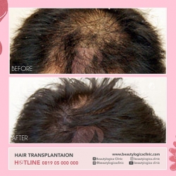 1_HAIR-TRANSPLANTAION-01