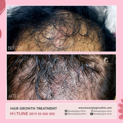 HAIR-GROWTH-TREATMENT-01