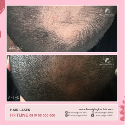 HAIR-LASER-01