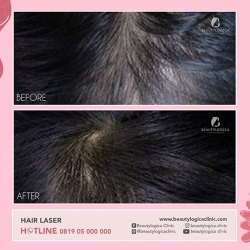 HAIR-LASER-02