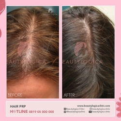 HAIR-PRP-01