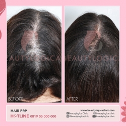 HAIR-PRP-02