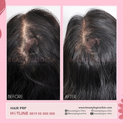 HAIR-PRP-03
