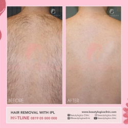 HAIR-REMOVAL-WITH-IPL-02
