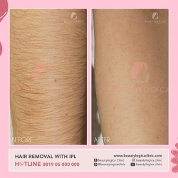 HAIR-REMOVAL-WITH-IPL-03