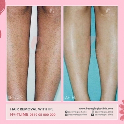 HAIR-REMOVAL-WITH-IPL-04