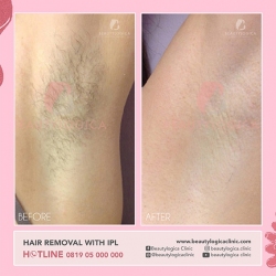 HAIR-REMOVAL-WITH-IPL-05
