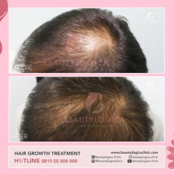 HAIR-STEMCELL-02