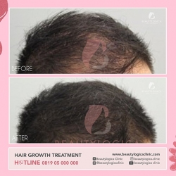 HAIR-STEMCELL-03