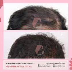 HAIR-STEMCELL-04