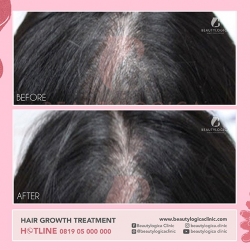 HAIR-STEMCELL-05