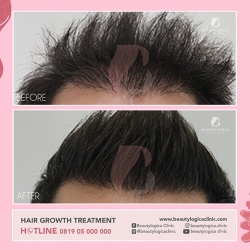 HAIR-STEMCELL-07