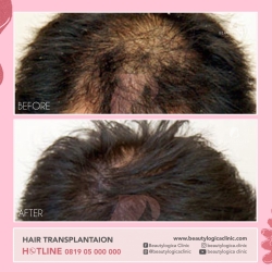 HAIR-TRANSPLANTAION-01