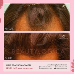 HAIR-TRANSPLANTAION-02